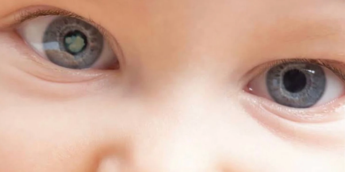 Congenital Cataract