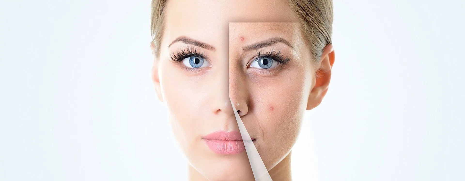 Scar (Blemish) Treatment