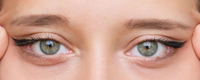 Ptosis