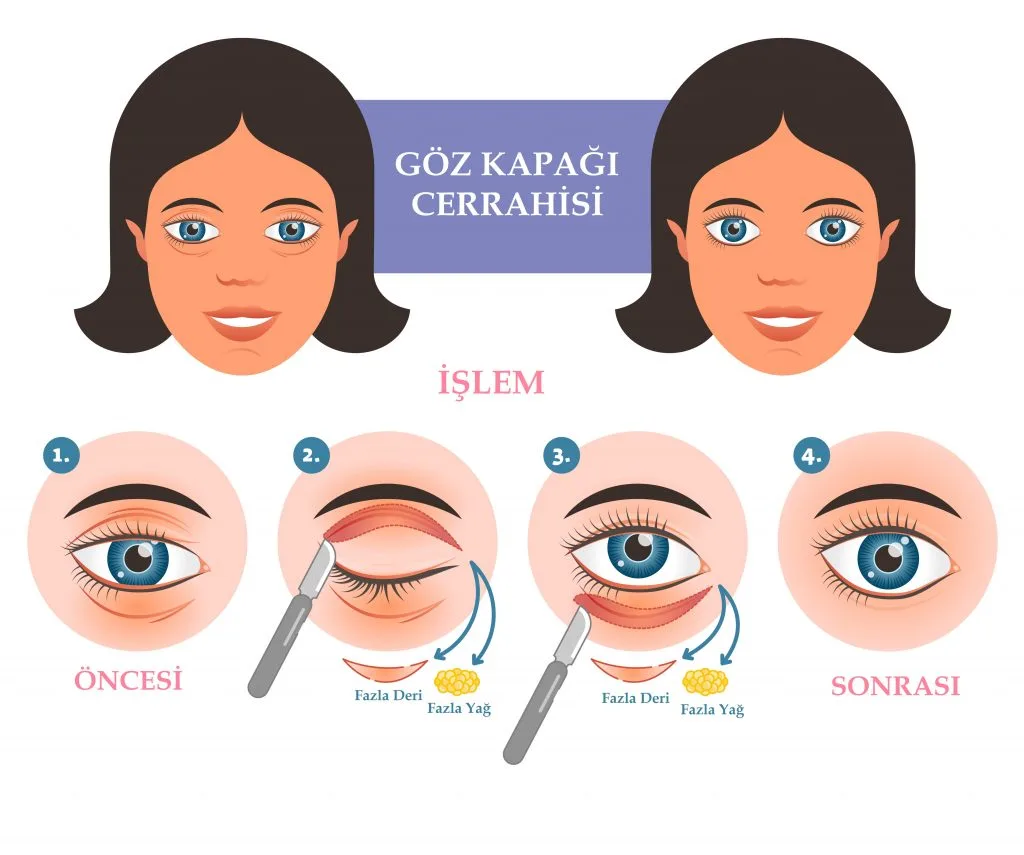 göz kapağı ameliyatı sonrası