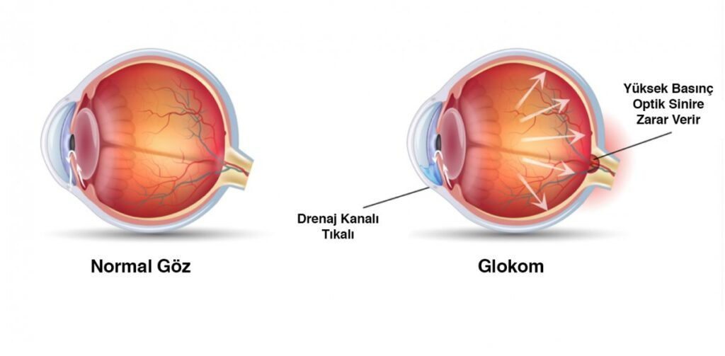 Göz tansiyonu Belirtileri, Evde glokom testi, Göz tansiyonu Kaç Olmalı