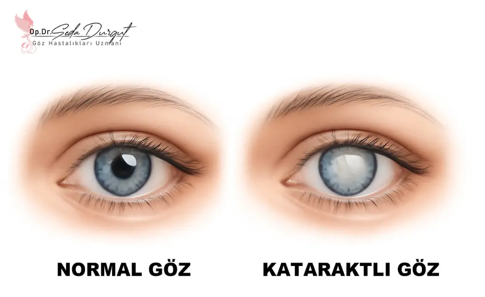 katarakt ameliyatı sonrası enfeksiyon belirtileri